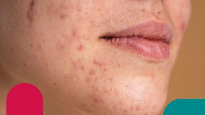 Acne: causas, sintomas e como resolver rápido